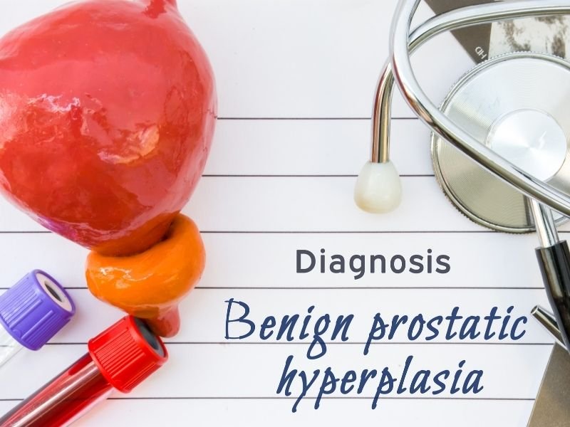 Hiperplasia Prostática Benigna - Dr. Javier Heredia