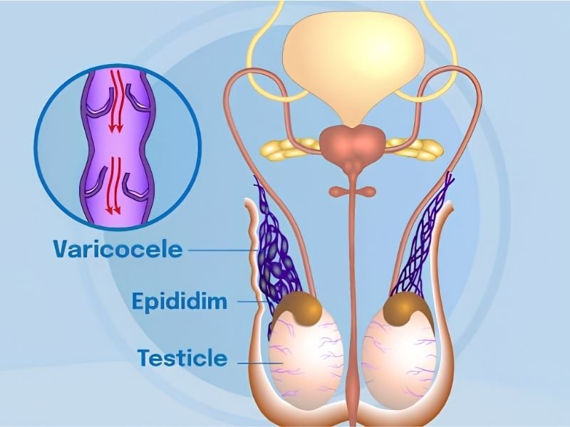 Diagnóstico y Tratamiento de Varicocele - Dr. Javier Heredia