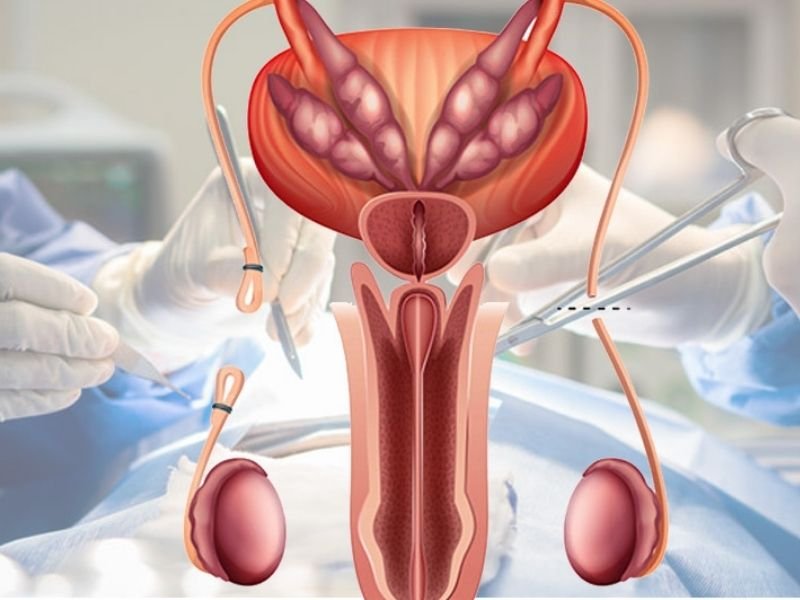 Vasectomía Sin Bisturí - Dr. Javier Heredia